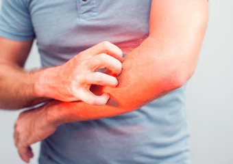 Atopowe zapalenie skóry – objawy, przyczyny, sposoby leczenia