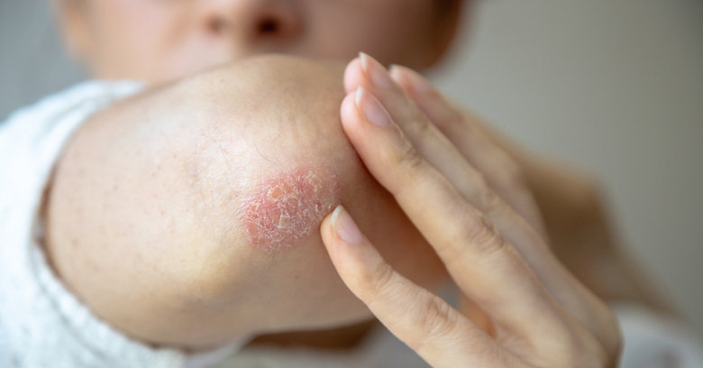 Łuszczyca – co to jest, przyczyny, objawy i leczenie łuszczycy