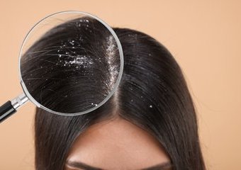 Jak pozbyć się łupieżu? Domowe sposoby na łupież