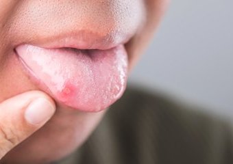 Jak się pozbyć afty?