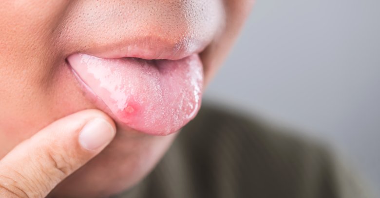 Jak się pozbyć afty?