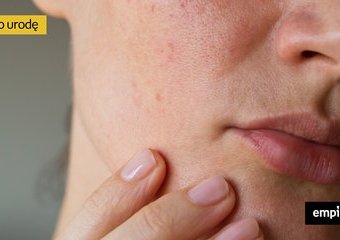 Łuszcząca się skóra na twarzy – jakie są przyczyny i co warto zastosować?