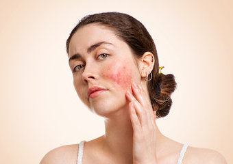 Stany zapalne na twarzy – skąd się biorą i jak je łagodzić?