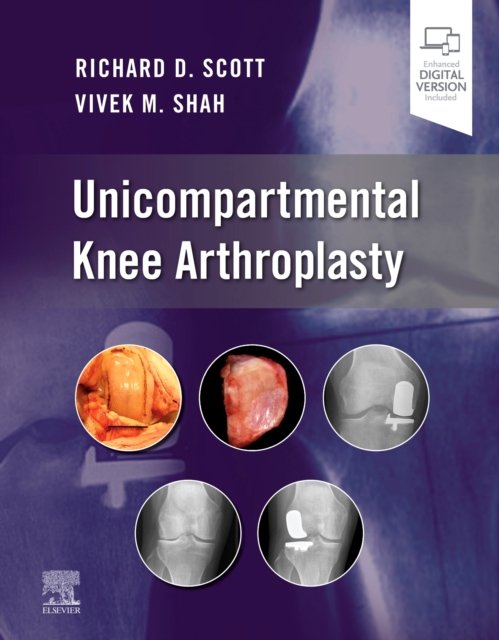 Unicompartmental Knee Arthroplasty - Opracowanie zbiorowe | Książka w Empik
