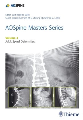 Aospine Master Series, Vol. 4: Adult Spinal Deformities Thieme Medical Publ Inc., Thieme Medical Publishers