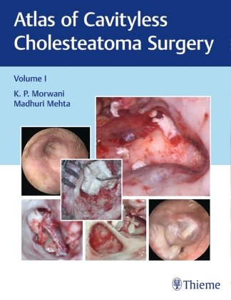 Atlas of Cavityless Cholesteatoma Surgery, Vol 1 Thieme, Stuttgart