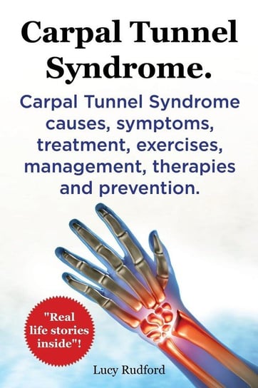 Carpal Tunnel Syndrome, Cts. Carpal Tunnel Syndrome Cts Causes, Symptoms, Treatment, Exercises, Management, Therapies and Prevention. Rudford Lucy