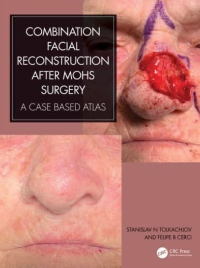 Combination Facial Reconstruction after Mohs Surgery: A Case Based Atlas Opracowanie zbiorowe