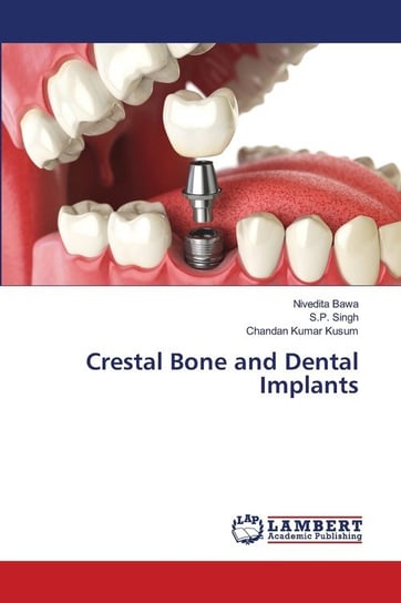Crestal Bone and Dental Implants Nivedita Bawa