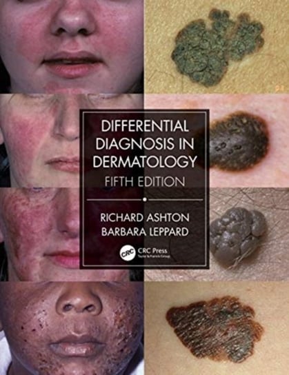 Differential Diagnosis in Dermatology Ashton Richard, Leppard Barbara