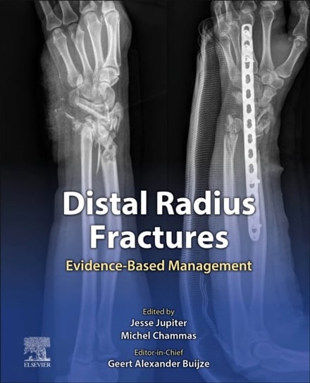 Distal Radius Fractures: Evidence-Based Management Jupiter