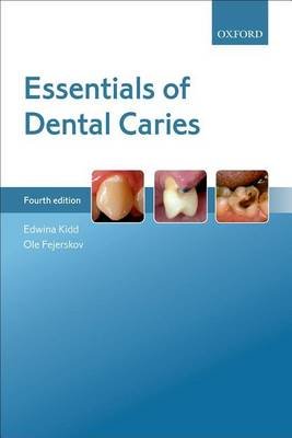 Essentials of Dental Caries Kidd Edwina A. M., Fejerskov Ole