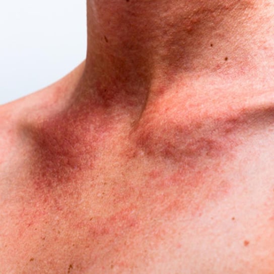 Jak sobie radzić z alergiami skórnymi i grzybicą? - Radioklinika - podcast Opracowanie zbiorowe
