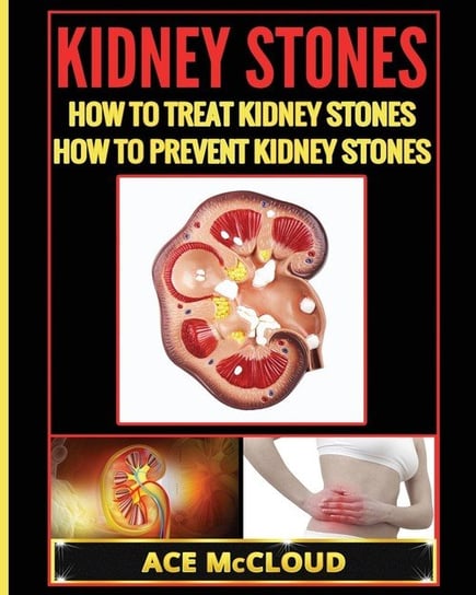 Kidney Stones Mccloud Ace