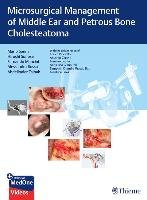 Microsurgical Management of Middle Ear and Petrous Bone Cholesteatoma Sanna Mario, Sunose Hiroshi, Mancini Fernando, Russo Alessandra, Taibah Abdelkader