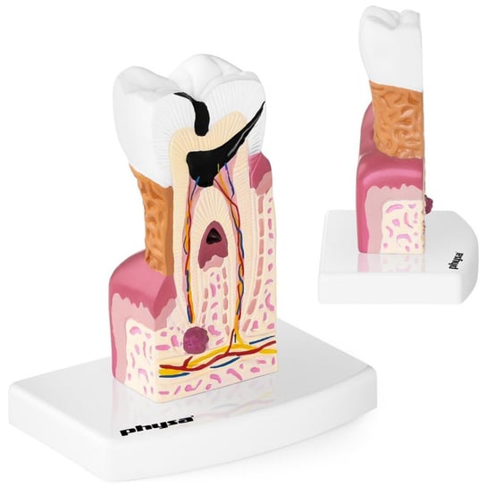 Model anatomiczny chorego zęba człowieka w skali 6:1 Physa