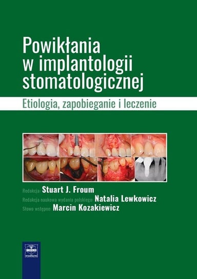 Powikłania w implantologii stomatologicznej. Etiologia, zapobieganie i leczenie Froum Stuart J.