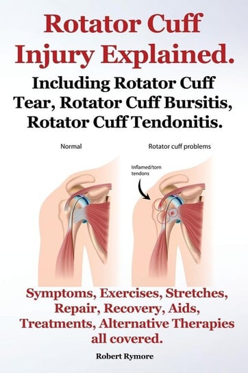 Rotator Cuff Injury Explained. Including Rotator Cuff Tear, Rotator Cuff Bursitis, Rotator Cuff Tendonitis. Symptoms, Exercises, Stretches, Repair, Re Rymore Robert