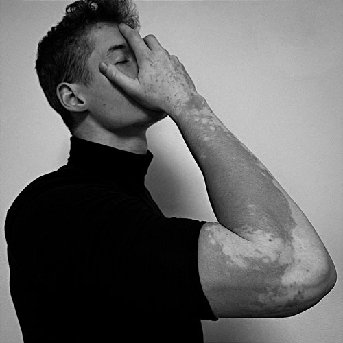 Skvrny Rainer, Dayne