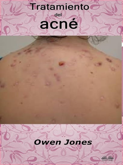 Tratamiento Del Acne Jones Owen