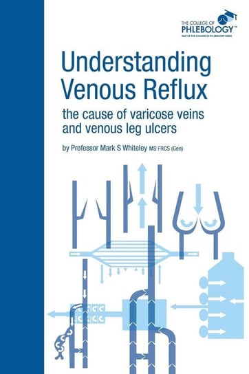 Understanding Venous Reflux the Cause of Varicose Veins and Venous Leg Ulcers Whiteley Mark S.
