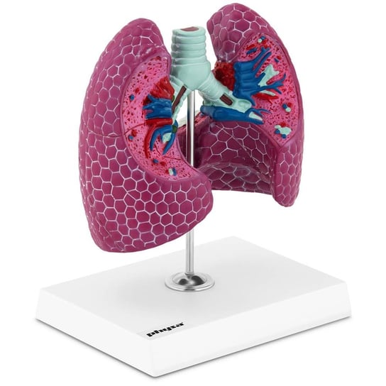 Upomnikarnia, Model anatomiczny 3D płuca człowieka ze zmianami chorobowymi Upomnikarnia