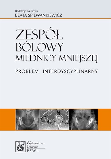 Zespół bólowy miednicy mniejszej. Problem interdyscyplinarny - ebook mobi Śpiewankiewicz Beata