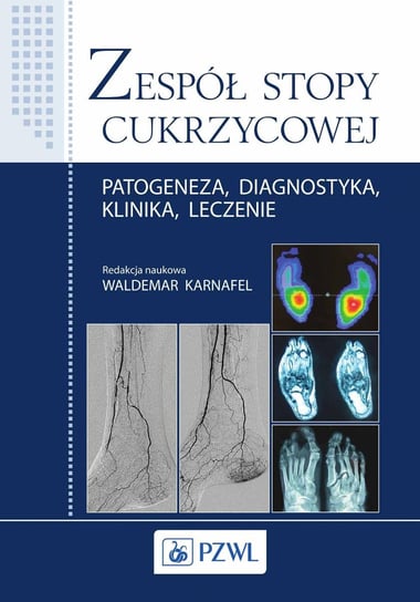 Zespół stopy cukrzycowej. Patogeneza, diagnostyka, klinika, leczenie - ebook mobi Karnafel Waldemar