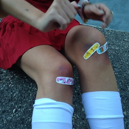 Bruise BETWEEN FRIENDS