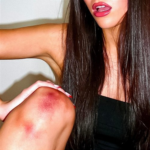 bruises Eli Swei, Next Generation